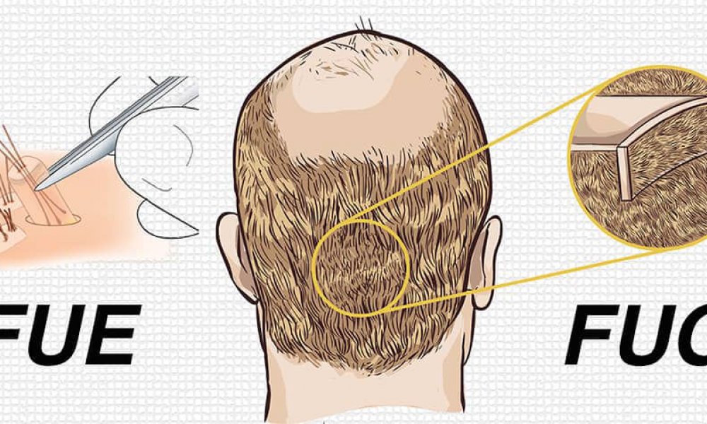 İstanbul doğal saç ekim merkezi