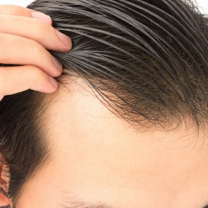 Saç Ekimi Kaç Seans Sürer?